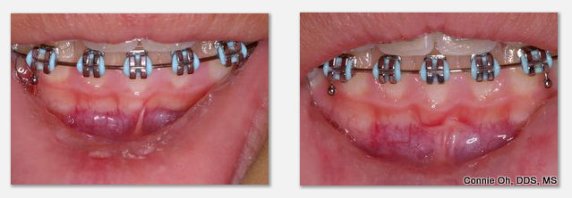 Before & After Lower Frenectomy