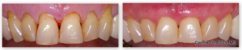Before & after gum grafting